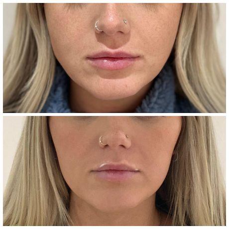 Botox Anti-wrinkle injections for teeth grinding and jawline slimming