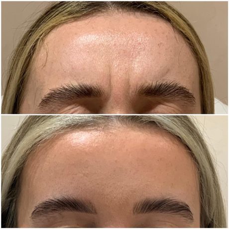 Botox anti-wrinkle injection treatment Forehead