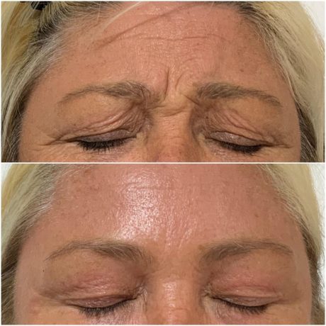 Anti wrinkle injections or Botox at SF Aesthetics Wigan