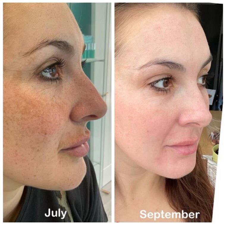 Alumier Skincare Hyperpigmentation Treatment with chemical peel