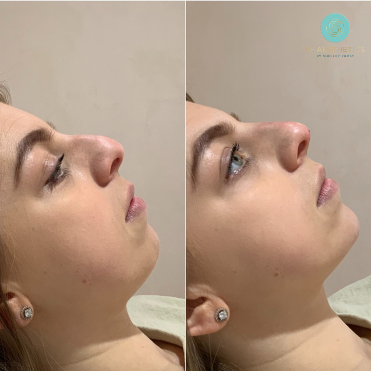 Non-Surgical Rhinoplasty: Reshaping Your Nose with Precision and Ease