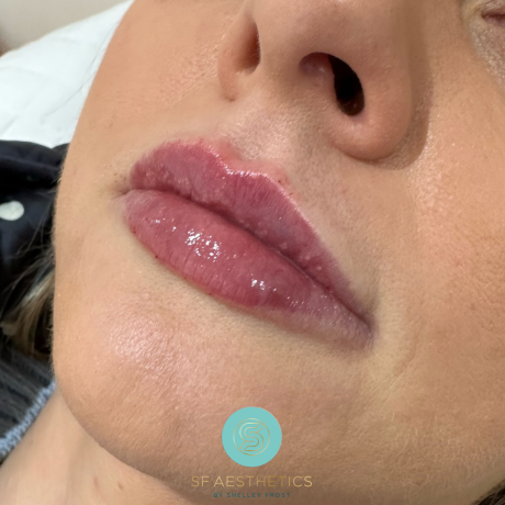 Lip Fillers augmentation with dermal fillers at SF Aesthetics Wigan