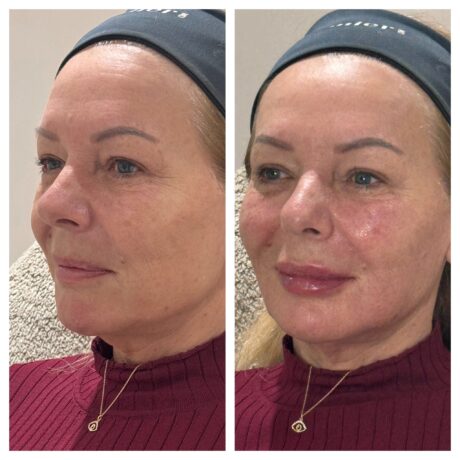 Dermal Fillers - Full Face rejuvenation at SF Aesthetics Wigan