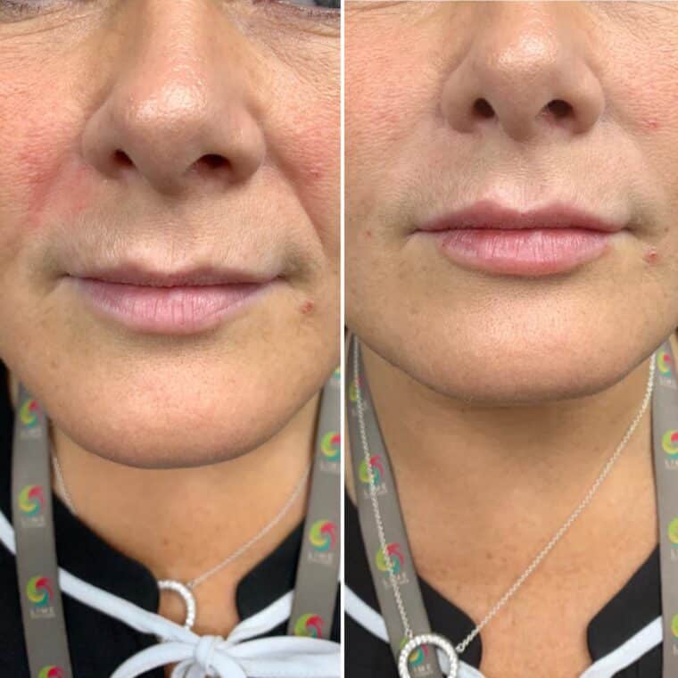 Nasolabial Filler Wigan - Smile Lines Treatment by a Nurse Prescriber
