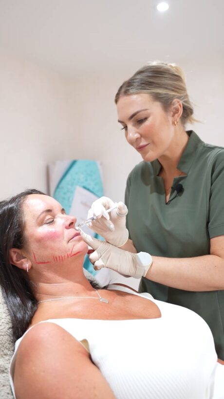 nasolabial filler Markings for nasolabial fold otherwise know and smile lines filler.