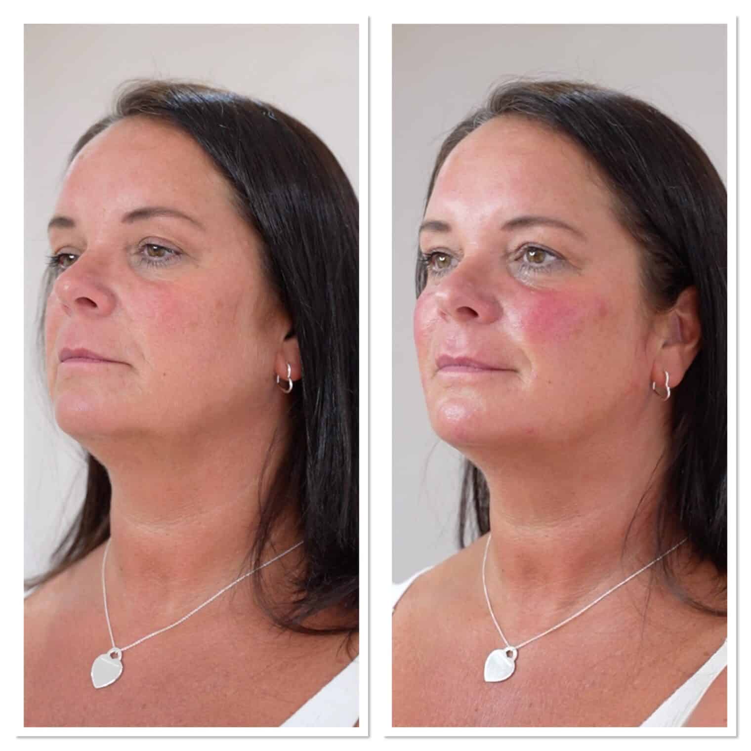 chin and jawline fillers before and after results