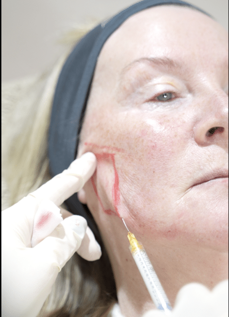 Chin and jawline filler at SF Aesthetics Wigan