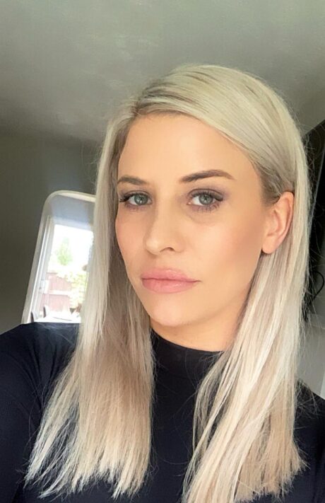 Rachaels Profhilo Journey at SF Aesthetics Wigan