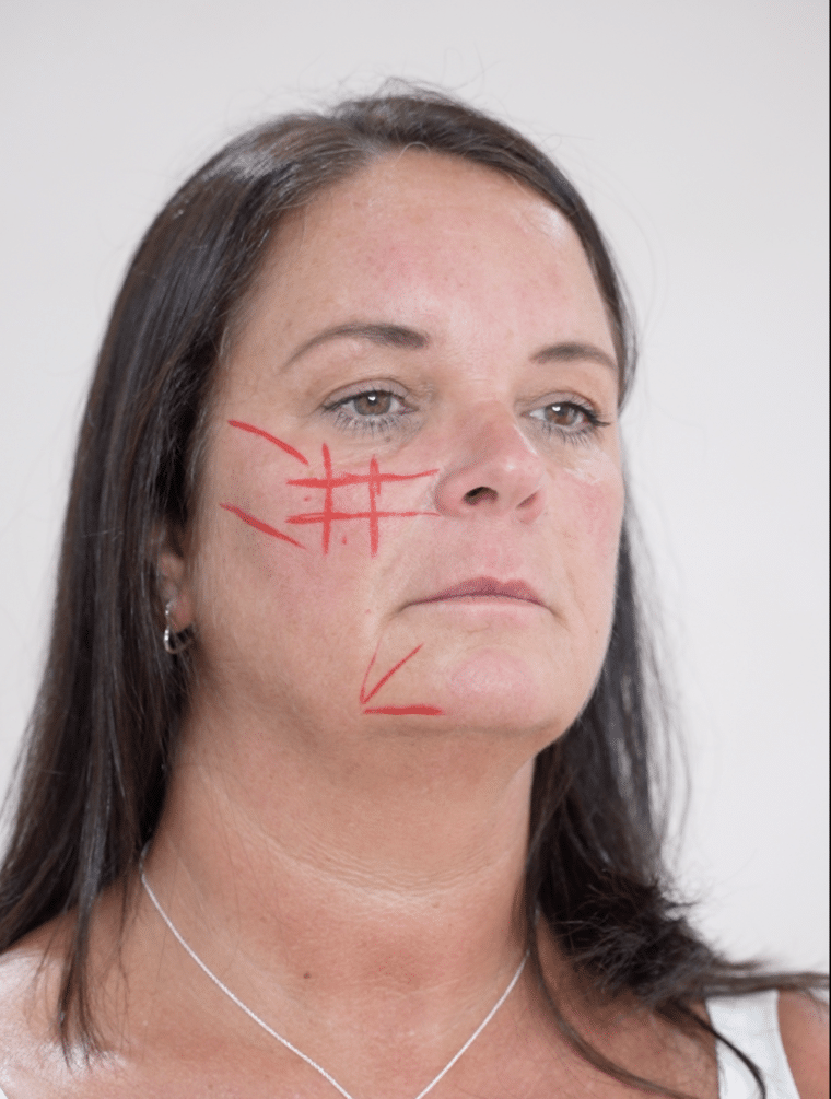 Marionette Lines Filler in Wigan — Softening Deep Folds by a Nurse Prescriber