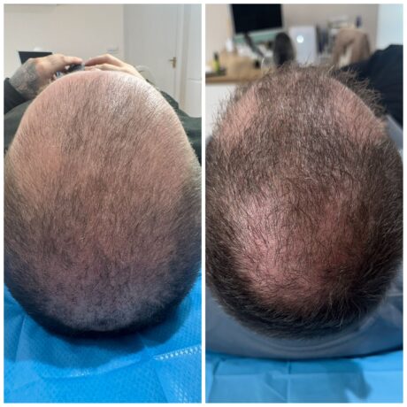 Exosomes for hair loss - Exosome Therapy for hair loss at SF Aesthetics Wigan