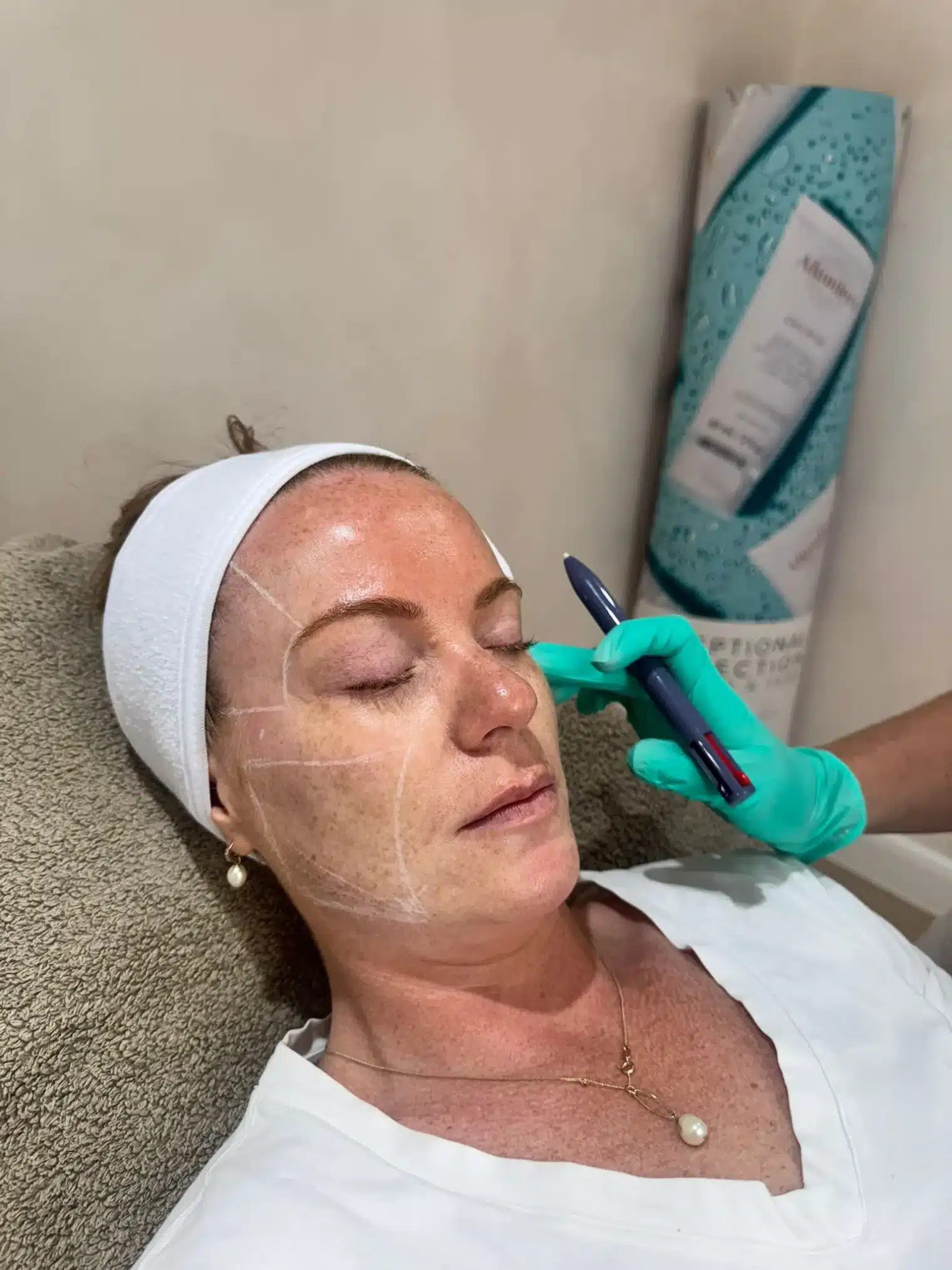 sculptra treatment in wigan at SF Aesthetics