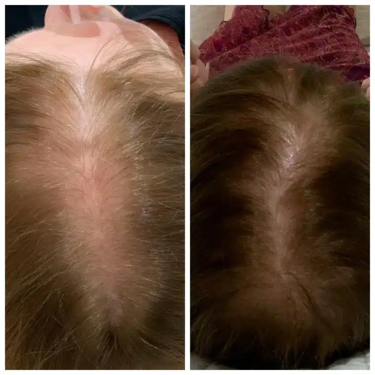 PRP vs Exosomes — Which Female Hair Loss Treatment Is Right for You