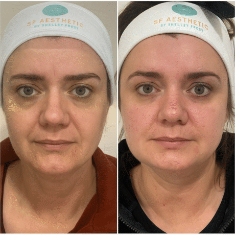 Sculptra Wigan before and after at SF Aesthetics