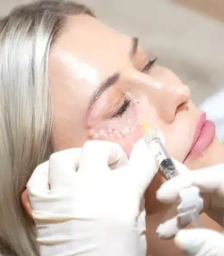 Polynucleotide Treatment - Under eye treatment Wigan