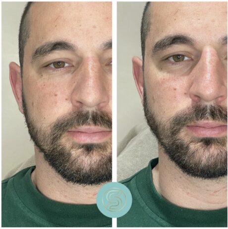 Jawline fillers for men at SF Aesthetics Wigan