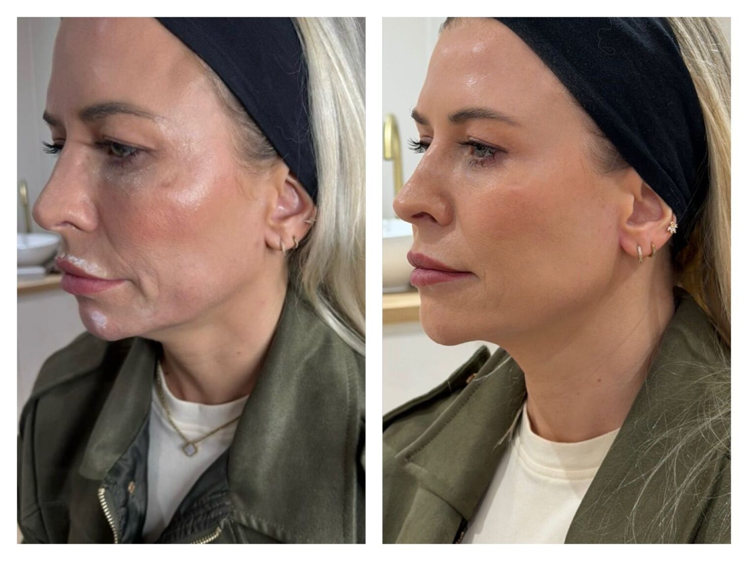 Jawline fillers in women