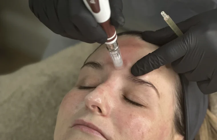 How Much Does Microneedling Cost in Wigan? Your 2026 Pricing Guide