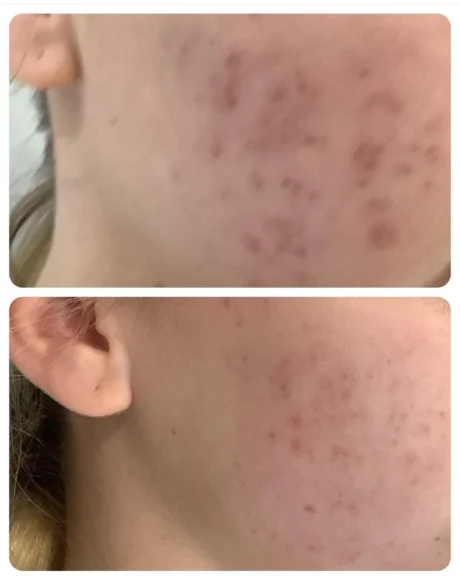 Before-and-after close-ups of a cheek showing inflammatory acne on the top image and clearer skin with fewer blemishes on the bottom image.